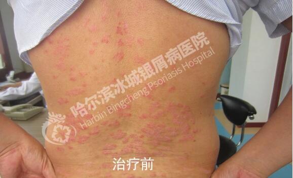 银屑病图片